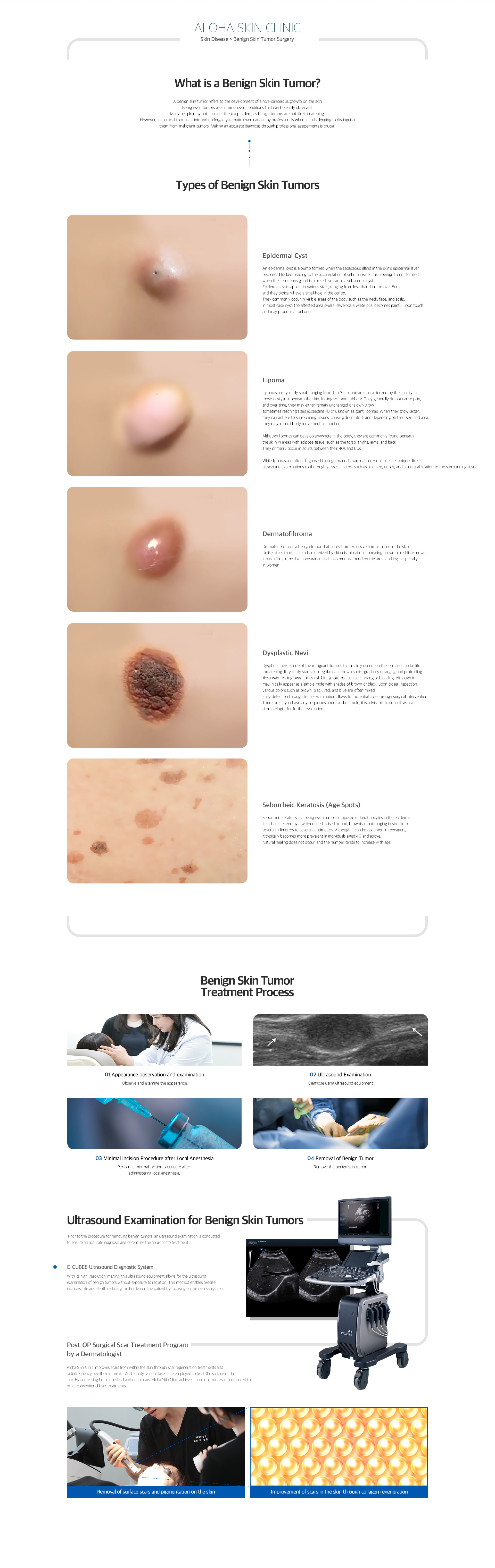 Benign skin tumor surgery