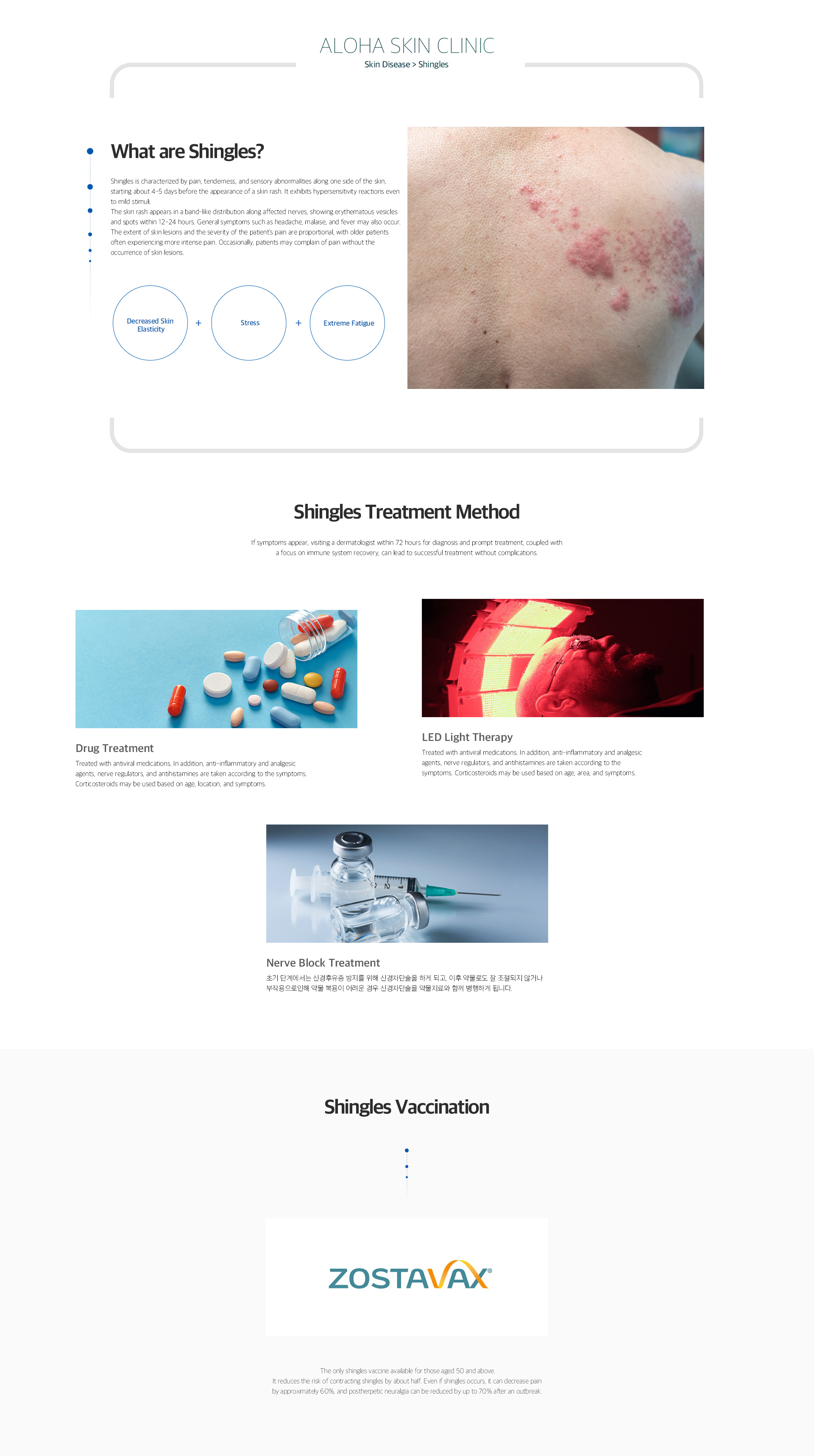 Shingles